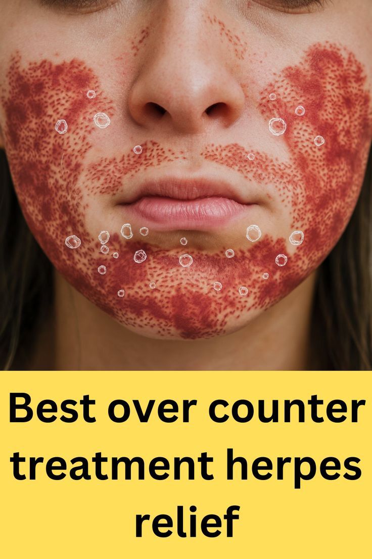 ✨ Best Over-the-Counter Treatment for Herpes? ✨